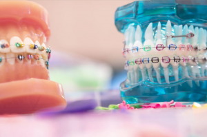 Types of orthodontic appliances