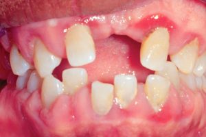 Periodontal Disease