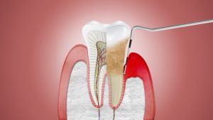 What do you need to know about Periodontal diseases?