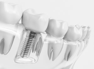 Dental Implant Process